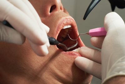 How Often Do You Really Need a Dental Cleaning?
